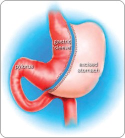 Laparoscopic Roux-en-Y Gastric Bypass